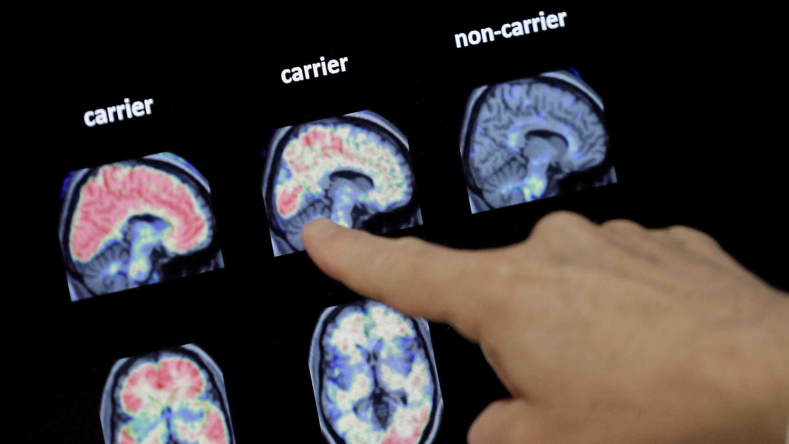 Alzheimer's researchers are looking beyond plaques and tangles for new